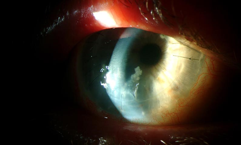 Clinical eye photograph illustrating Nontuberculous Mycobacterial Keratitis