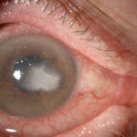 Clinical eye photograph illustrating Numular Keratitis