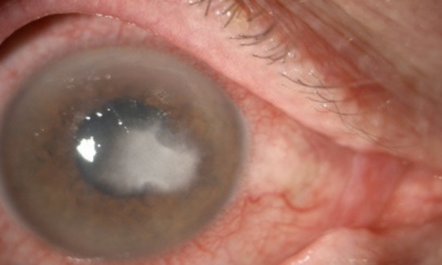 Nummular Keratitis: The Coin-Shaped Cousin of Herpetic Stromal Disease