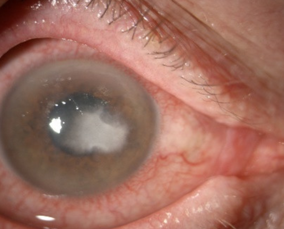 Clinical eye photograph illustrating Numular Keratitis
