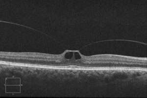 Clinical eye photograph illustrating Ocriplasmin Pharmacologic Vitreolysis