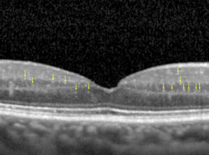 Clinical eye photograph illustrating Oct Hyperreflective Foci