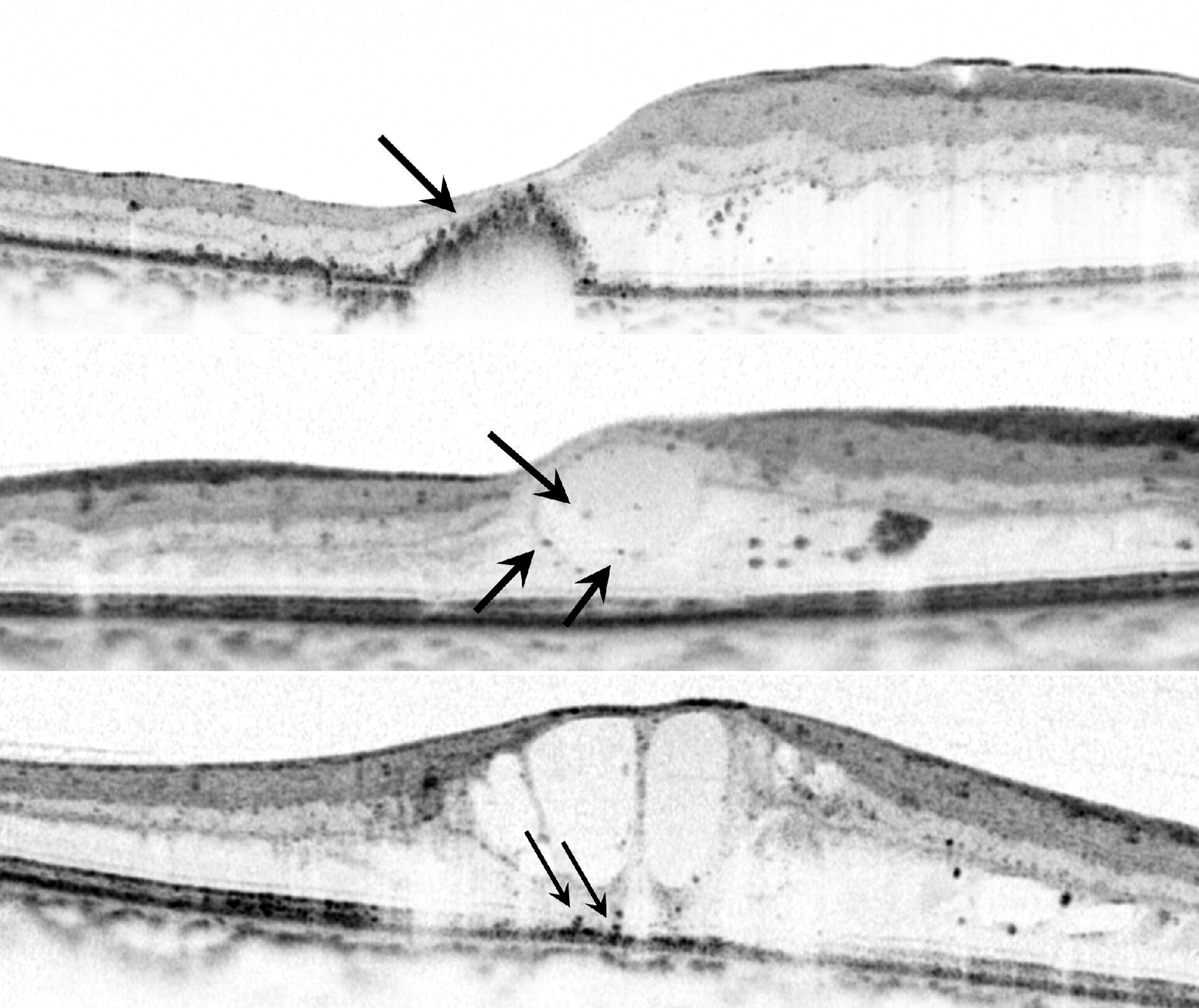 Clinical eye photograph illustrating Oct Hyperreflective Foci