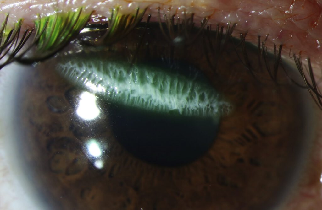 Clinical eye photograph illustrating Ocular First Aid