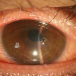 Clinical eye photograph illustrating Ocular Graft Versus Host Disease