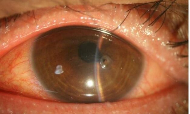 Ocular Graft-Versus-Host Disease: When a Bone Marrow Transplant’s Immune System Turns on the Eye