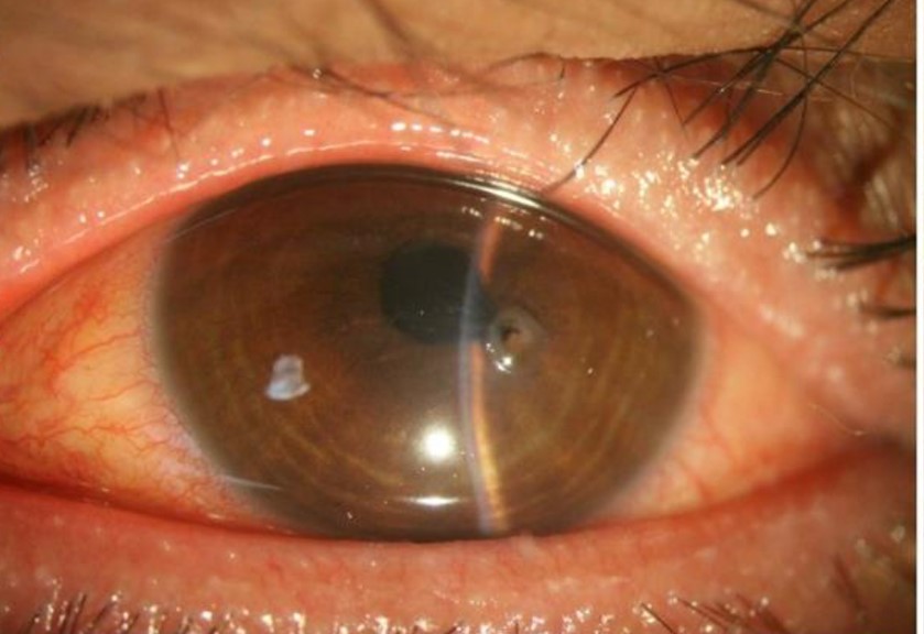 Clinical eye photograph illustrating Ocular Graft Versus Host Disease