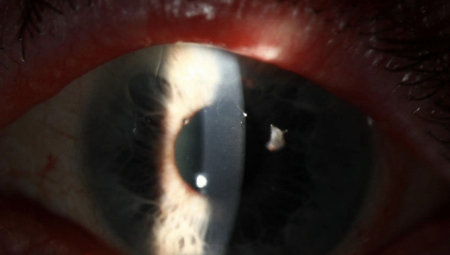 Clinical eye photograph illustrating Ocular Graft Versus Host Disease