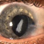 Clinical eye photograph illustrating Ocular Trauma Score