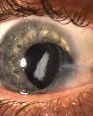 Clinical eye photograph illustrating Ocular Trauma Score