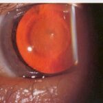 Clinical eye photograph illustrating Oil Droplet Cataract Galactosemia