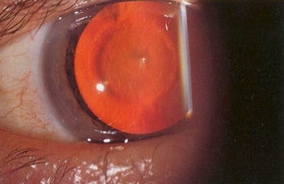 Oil-Droplet Cataract in Galactosemia: A Reversible Cataract If the Diagnosis Is Made Early