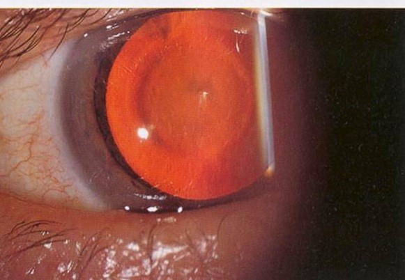 Oil-Droplet Cataract in Galactosemia: A Reversible Cataract If the Diagnosis Is Made Early