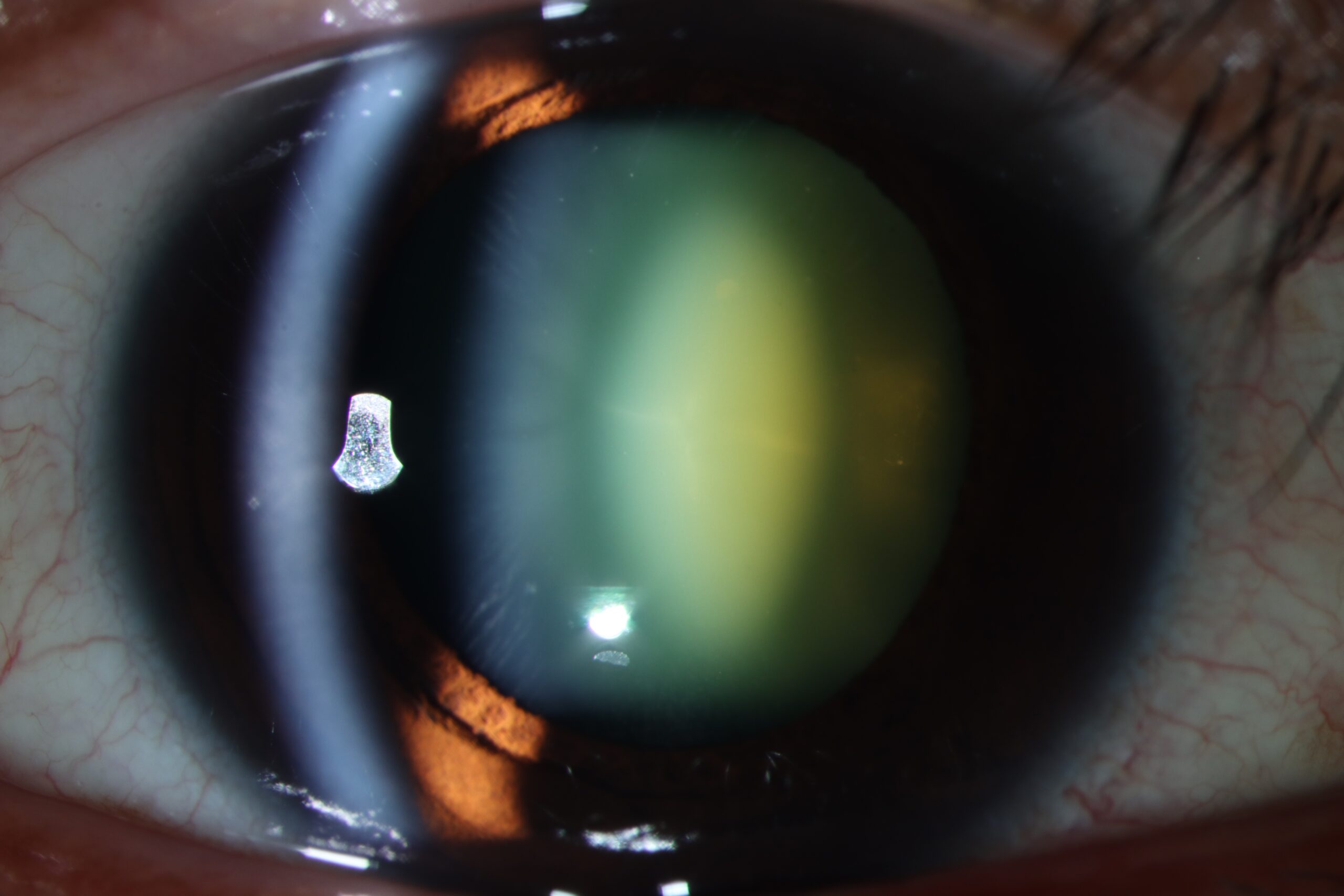Clinical eye photograph illustrating Oil Droplet Cataract Galactosemia