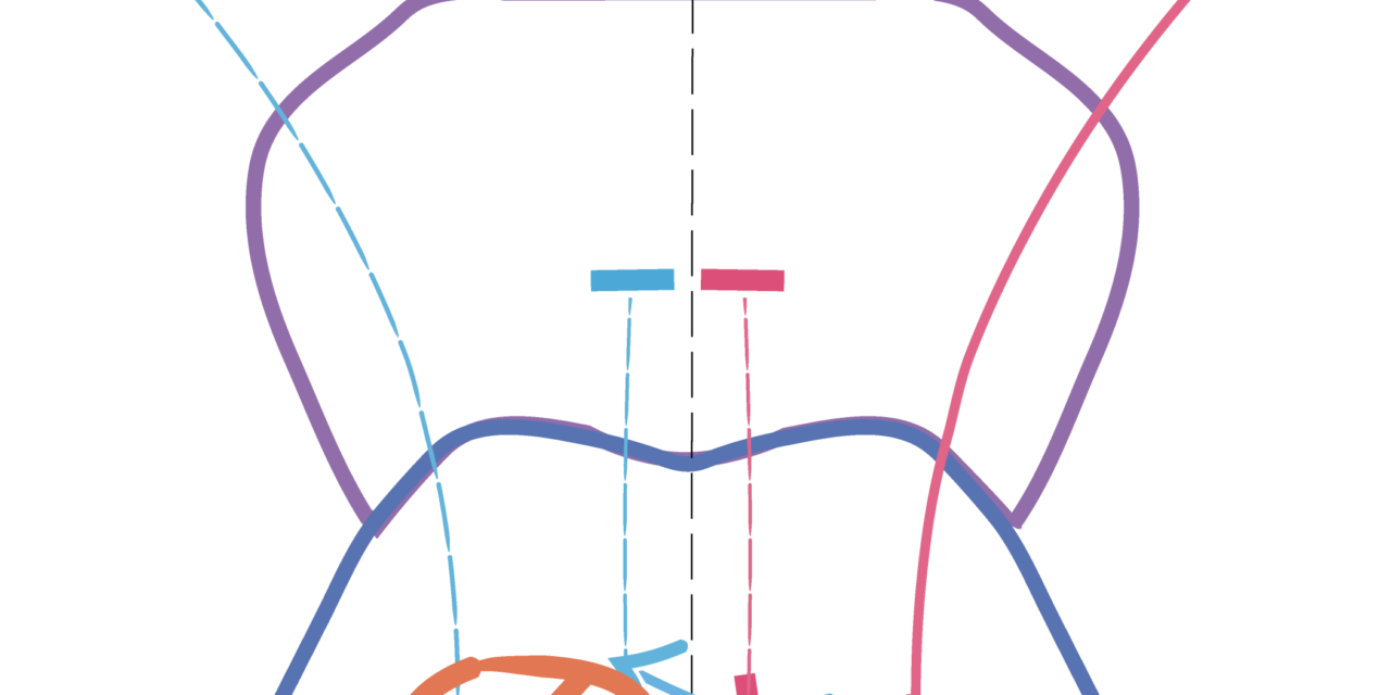 One-and-a-Half Syndrome: Localizing a Single Brainstem Lesion From the Eye Movements Alone