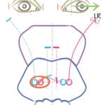 Clinical eye photograph illustrating One and a Half Syndrome Brainstem Lesion