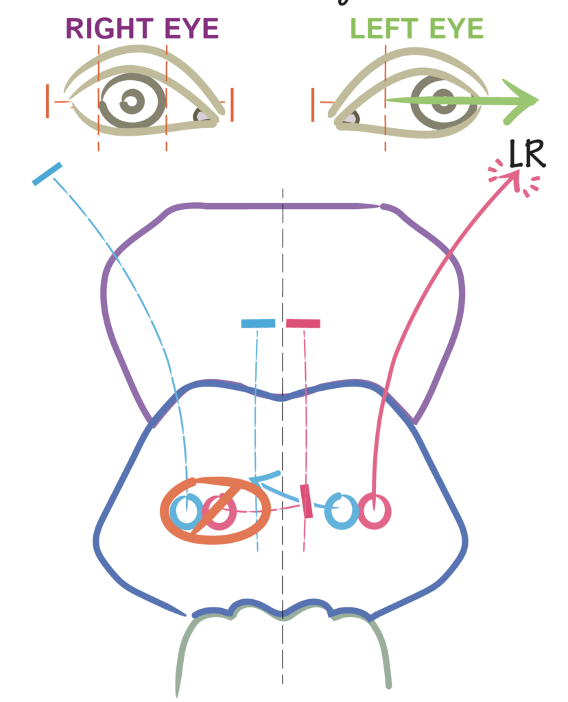 Clinical eye photograph illustrating One and a Half Syndrome Brainstem Lesion