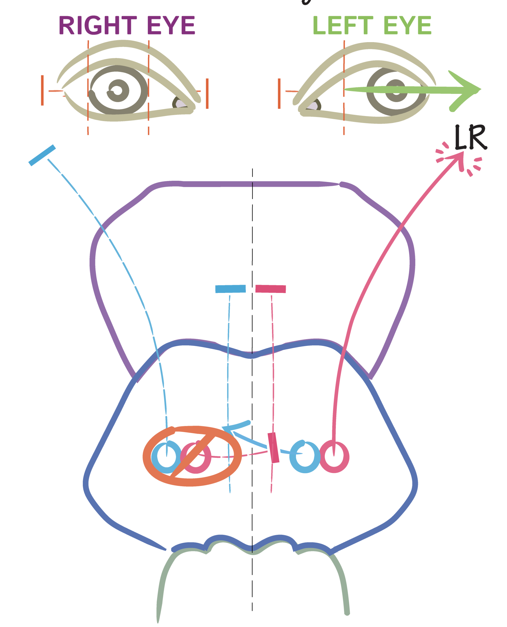 Clinical eye photograph illustrating One and a Half Syndrome Brainstem Lesion