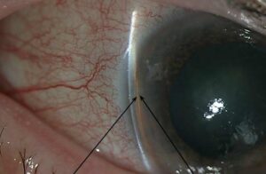 Clinical image illustrating Open-Angle vs Angle-Closure Glaucoma