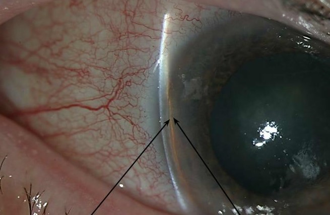 Clinical image illustrating Open-Angle vs Angle-Closure Glaucoma