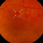 Clinical eye photograph illustrating Operculated Retinal Hole