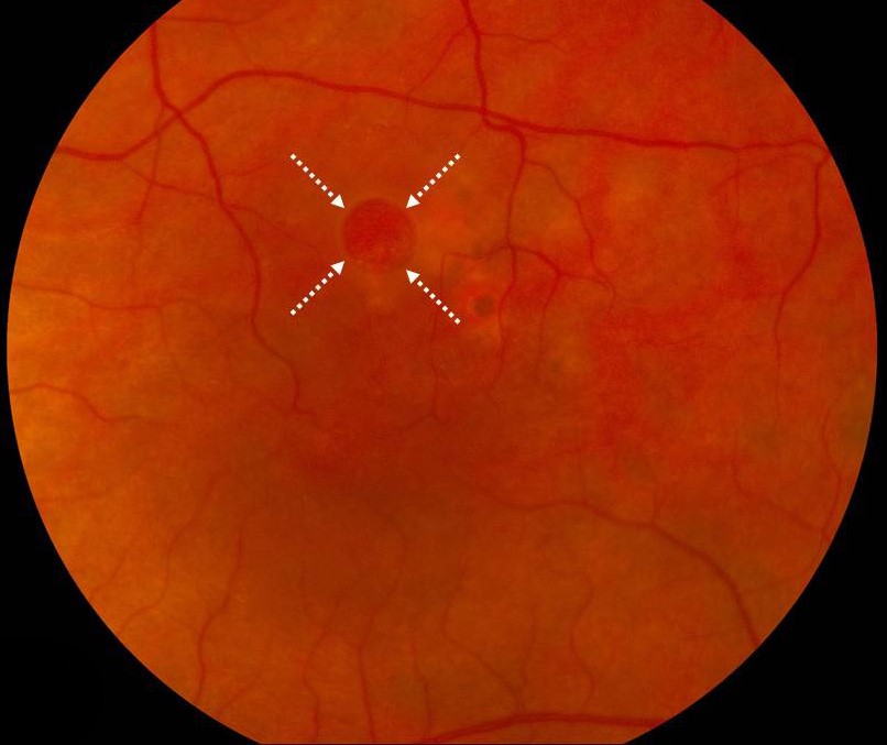 Clinical eye photograph illustrating Operculated Retinal Hole