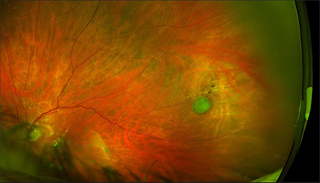 Clinical eye photograph illustrating Operculated Retinal Hole