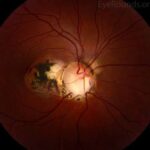 Clinical eye photograph illustrating Optic Disc Coloboma