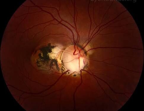 Optic Disc Coloboma: A Gap Left From an Embryonic Seam That Never Closed