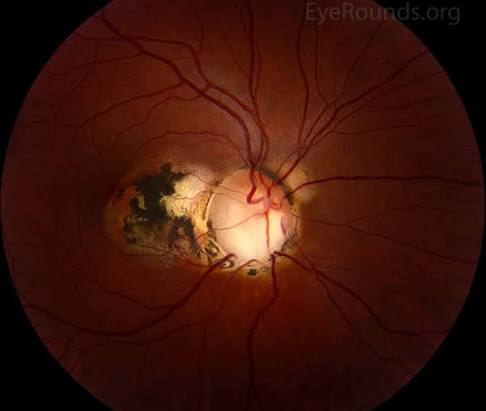Clinical eye photograph illustrating Optic Disc Coloboma
