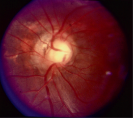 Clinical eye photograph illustrating Optic Disc Coloboma