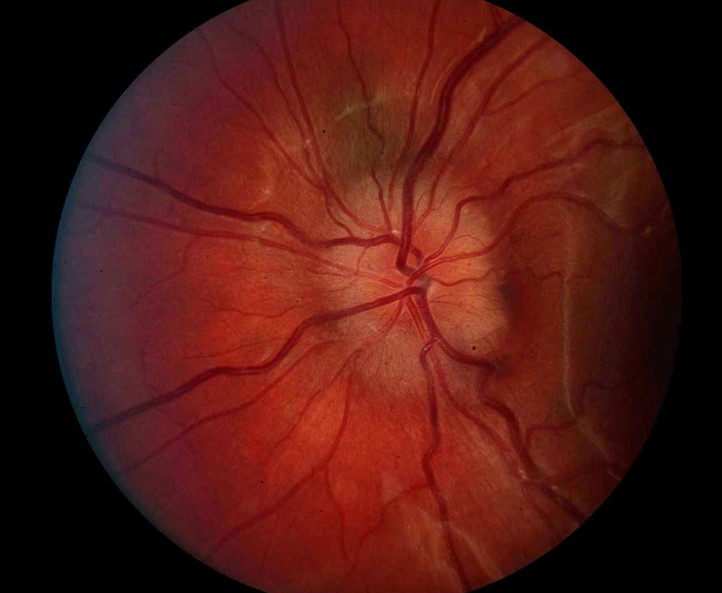Clinical eye photograph illustrating Optic Disc Edema Causes Differential