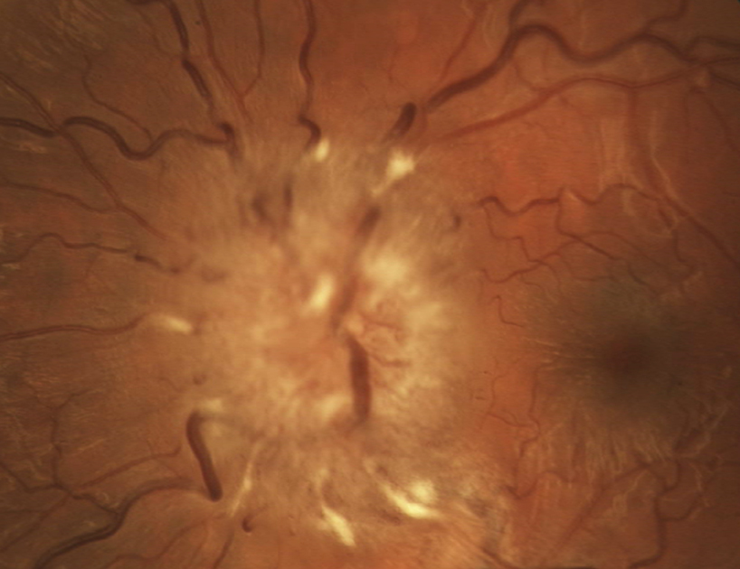 Clinical eye photograph illustrating Optic Disc Edema Causes Differential