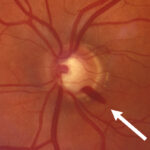Clinical eye photograph illustrating Optic Disc Hemorrhage Glaucoma