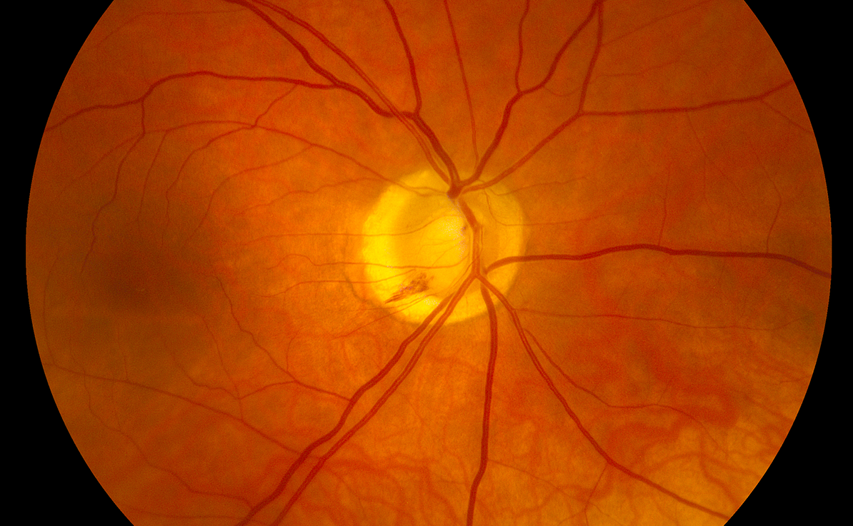 Clinical eye photograph illustrating Optic Disc Hemorrhage Glaucoma