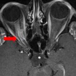 Clinical eye photograph illustrating Optic Nerve Sheath Meningioma