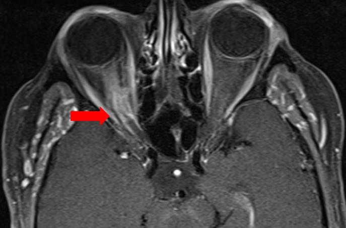 Clinical eye photograph illustrating Optic Nerve Sheath Meningioma