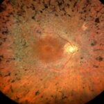 Clinical eye photograph illustrating Optogenetic Therapy Retina