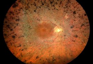 Clinical eye photograph illustrating Optogenetic Therapy Retina