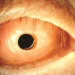 Clinical eye photograph illustrating Osteo Odonto Keratoprosthesis Indications
