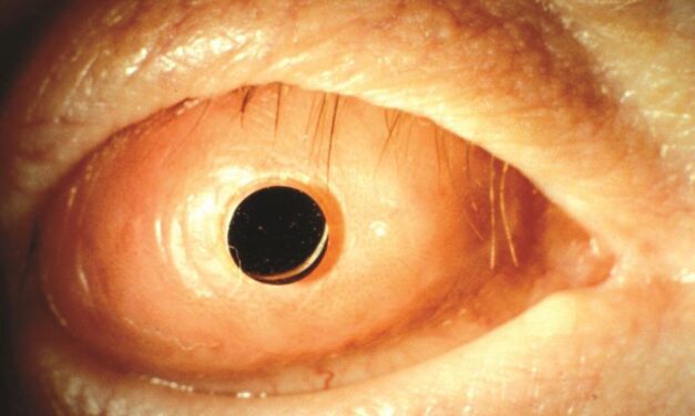 Osteo-Odonto-Keratoprosthesis: Rebuilding Vision With a Patient’s Own Tooth