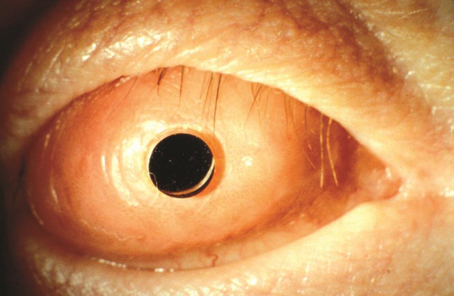 Clinical eye photograph illustrating Osteo Odonto Keratoprosthesis Indications