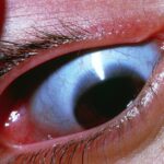 Clinical eye photograph illustrating Osteogenesis Imperfecta Ocular Findings