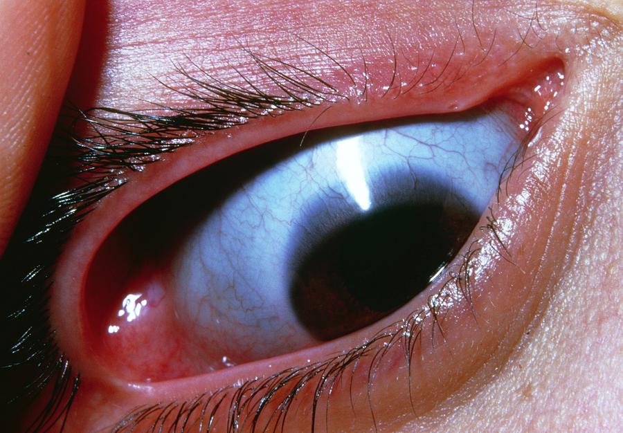 Clinical eye photograph illustrating Osteogenesis Imperfecta Ocular Findings