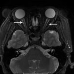 Clinical eye photograph illustrating Paraneoplastic Optic Neuropathy