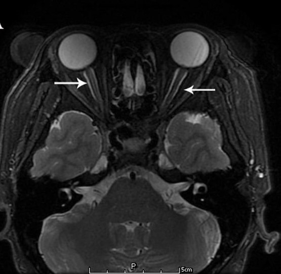 Clinical eye photograph illustrating Paraneoplastic Optic Neuropathy