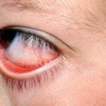 Clinical eye photograph illustrating Parinaud Oculoglandular Syndrome