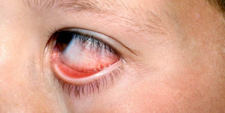 Clinical eye photograph illustrating Parinaud Oculoglandular Syndrome