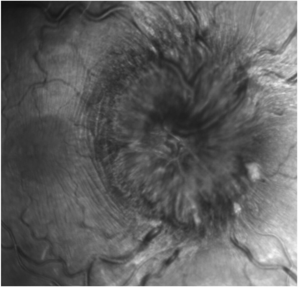 Clinical image illustrating Paton Lines (Disc Folds)