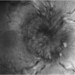 Clinical image illustrating Paton Lines (Disc Folds)